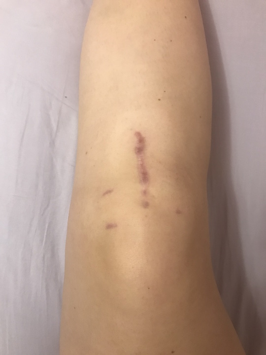 View of knee scar